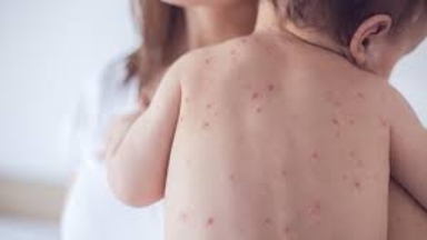 Алаңдатарлық көрсеткіш: Алматыда қызылшамен ауырғандар саны күрт артқан