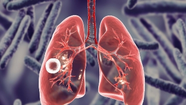 Алматыда колледж студентінен туберкулез анықталды